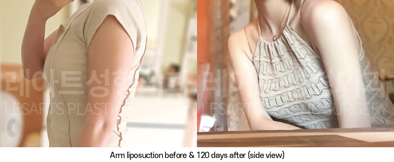 arm_liposuction_02_08_250320