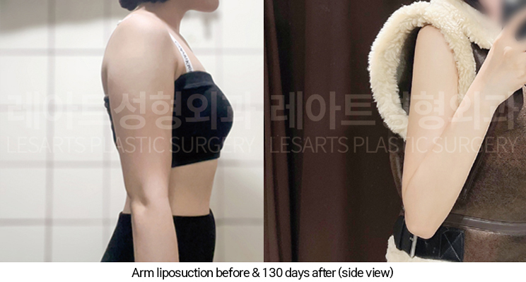 arm_liposuction_02_08_250327
