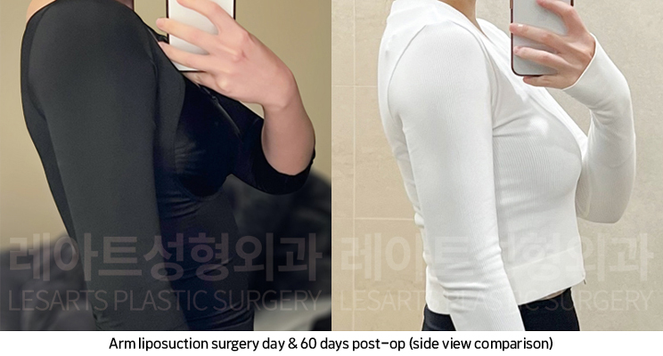 arm_liposuction_02_09_250219