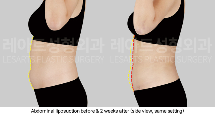 arm_liposuction_02_09_250311