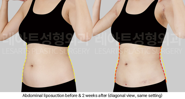 arm_liposuction_02_10_250311