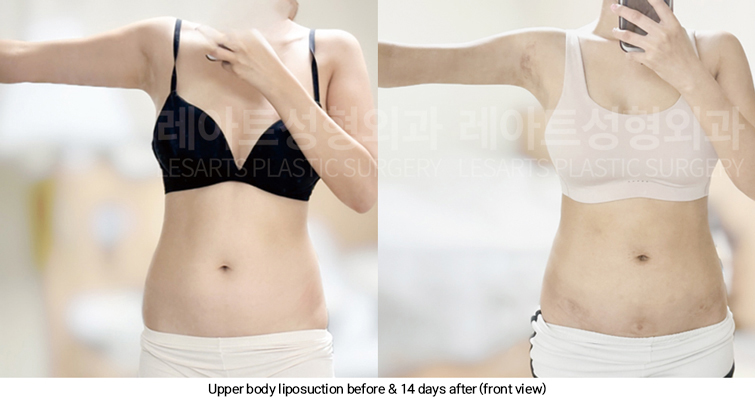arm_liposuction_02_11_250311