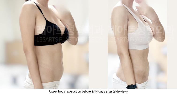 arm_liposuction_02_12_250311