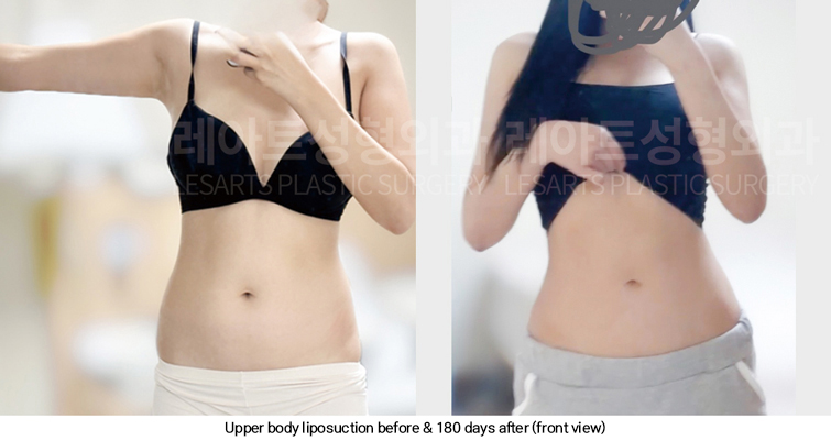 arm_liposuction_02_13_250311
