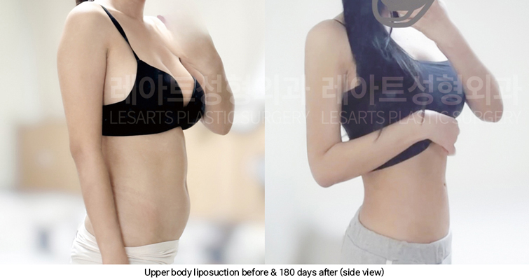 arm_liposuction_02_14_250311