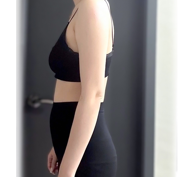 ide profile before arm liposuction by engdp showing upper arm volume.