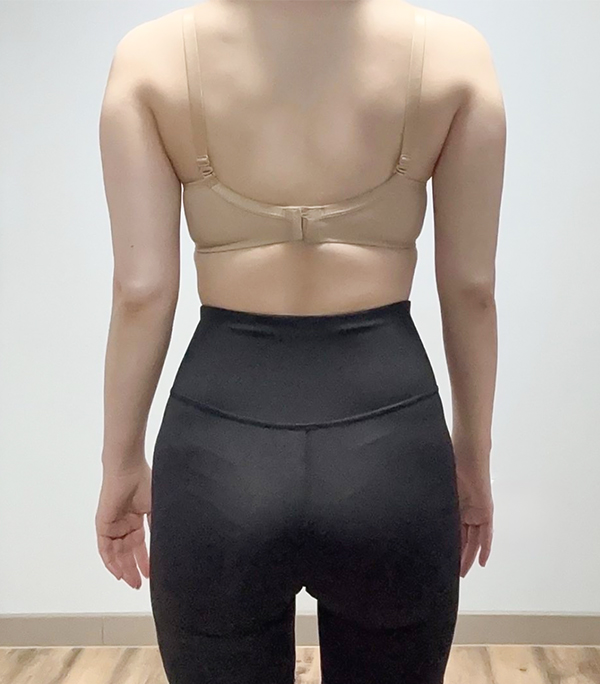 Before photo of upper arm showing excess fat from gasyoying before arm liposuction at Lesarts.