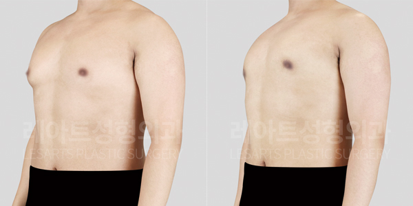 gynecomastia_01_thumbnail_250403