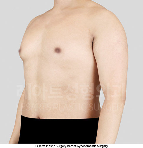 gynecomastia_02_01_250403