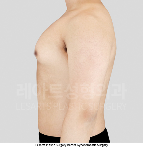 gynecomastia_02_02_250403