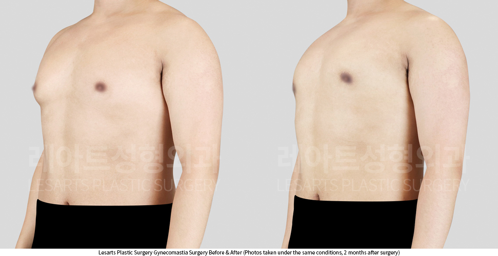 gynecomastia_02_03_250403