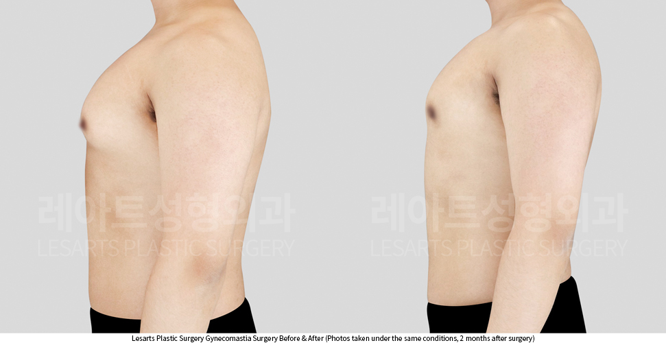 gynecomastia_02_04_250403