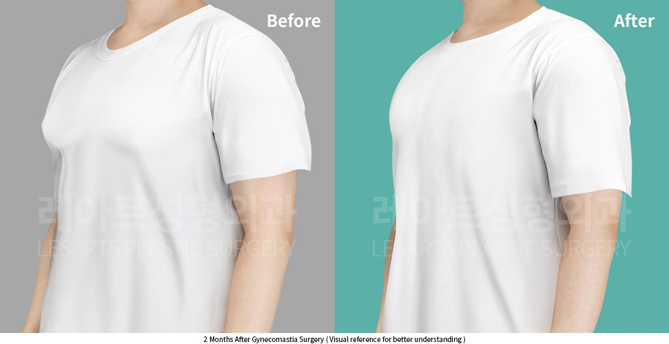 gynecomastia_02_05_250403