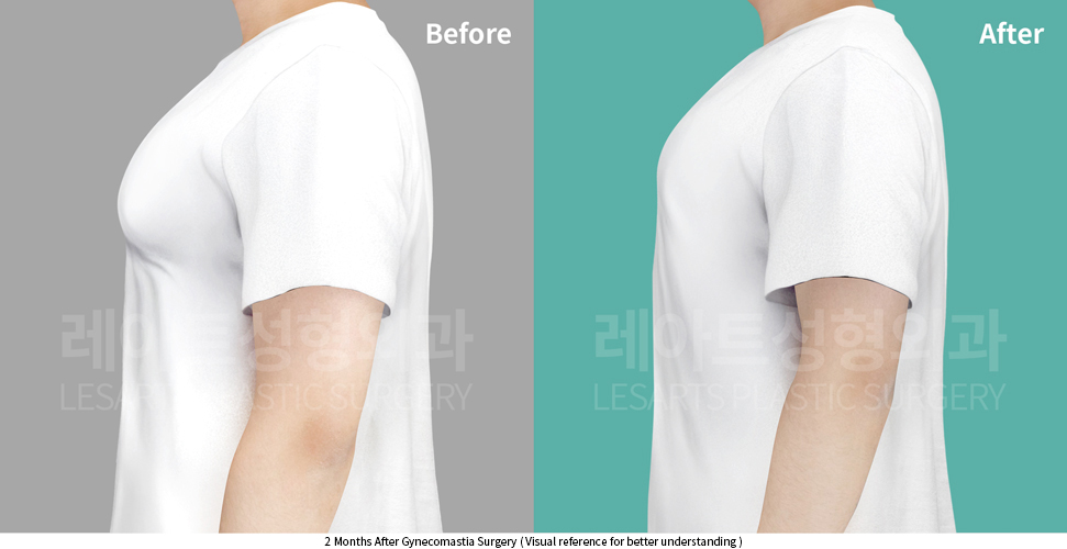 gynecomastia_02_06_250403