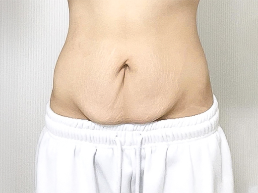 Before photo of hehegnya showing sagging abdominal skin before tummy tuck at Lesarts Plastic Surgery in Korea.