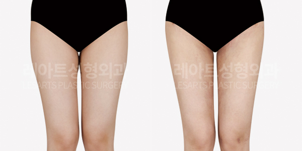 hip_dip_fat_transfer_01_thumbnail_250307