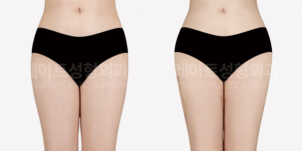 hip_dip_fat_transfer_01_thumbnail_250402
