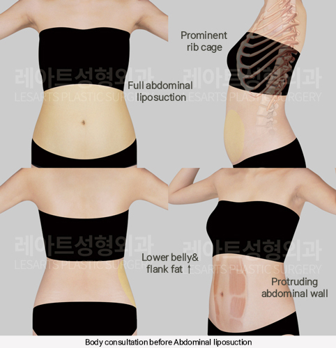 hip_dip_fat_transfer_02_01_250305