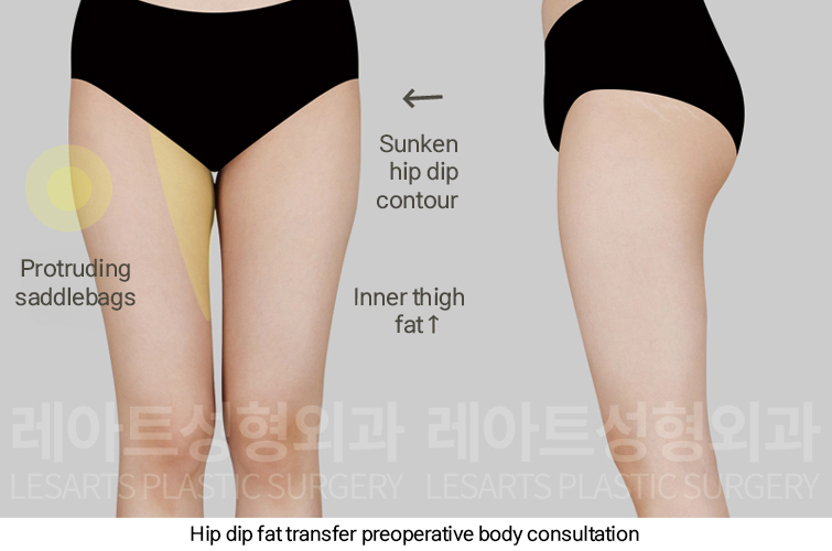 hip_dip_fat_transfer_02_01_250307