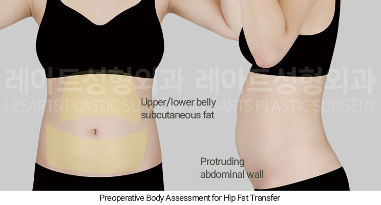 hip_dip_fat_transfer_02_01_250402