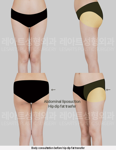 hip_dip_fat_transfer_02_02_250305