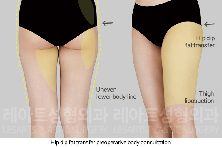 hip_dip_fat_transfer_02_02_250307