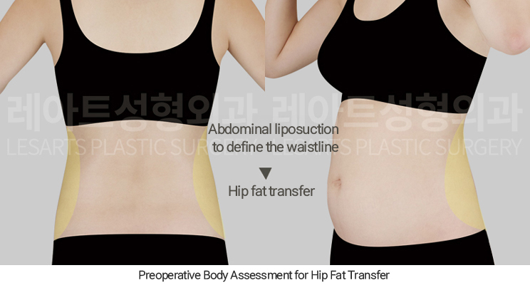 hip_dip_fat_transfer_02_02_250402