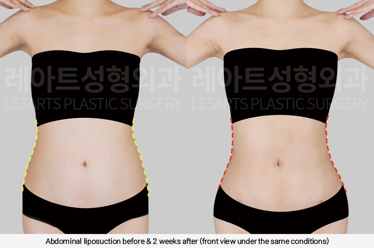 hip_dip_fat_transfer_02_03_250305