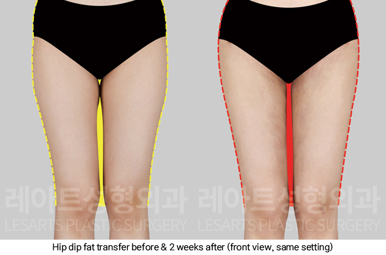 hip_dip_fat_transfer_02_03_250307