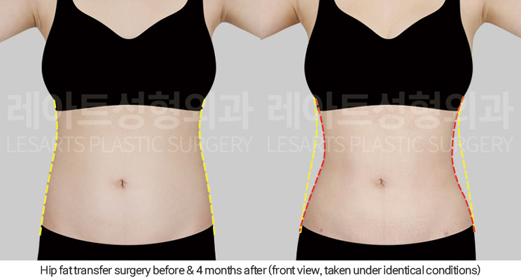 hip_dip_fat_transfer_02_03_250402