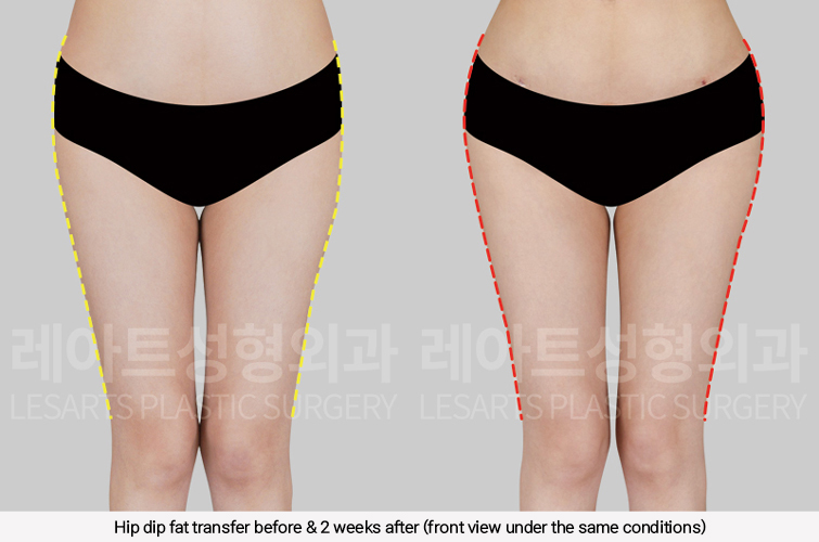 hip_dip_fat_transfer_02_04_250305
