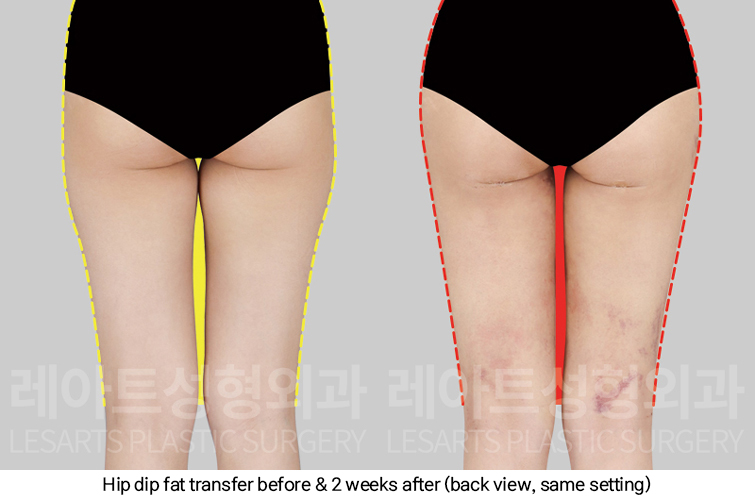 hip_dip_fat_transfer_02_04_250307