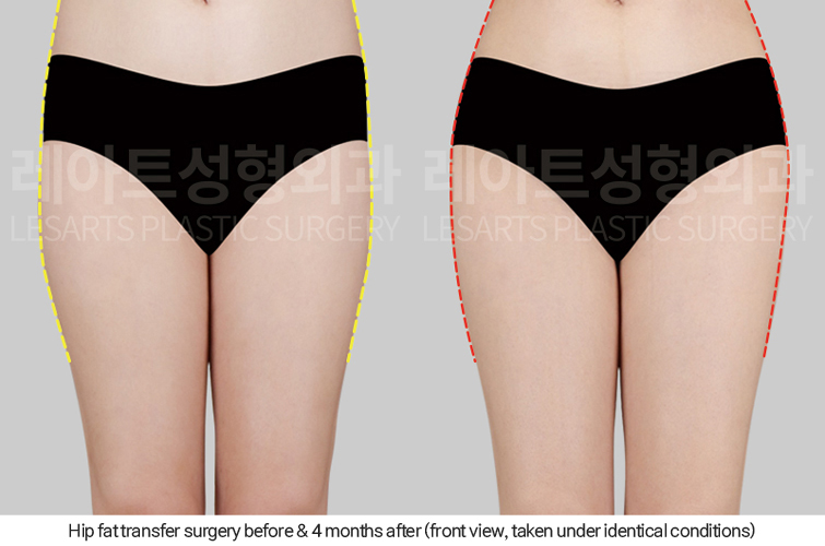 hip_dip_fat_transfer_02_04_250402