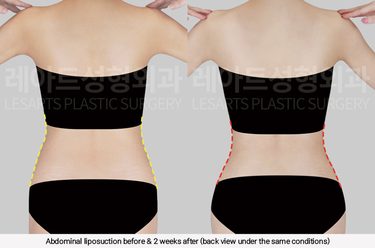 hip_dip_fat_transfer_02_05_250305
