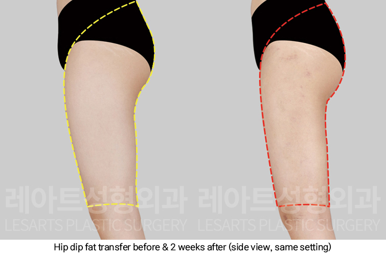 hip_dip_fat_transfer_02_05_250307