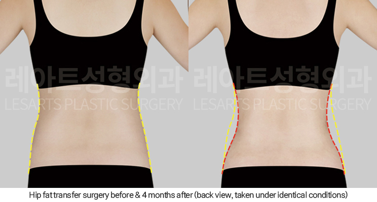 hip_dip_fat_transfer_02_05_250402