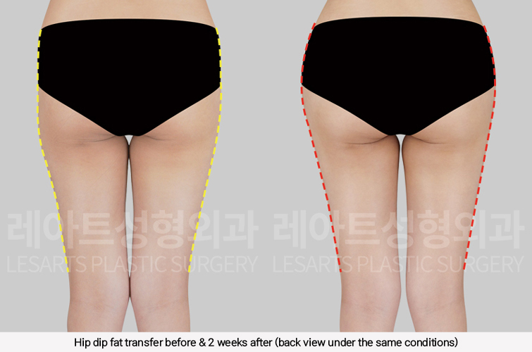 hip_dip_fat_transfer_02_06_250305