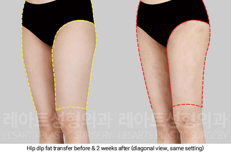 hip_dip_fat_transfer_02_06_250307