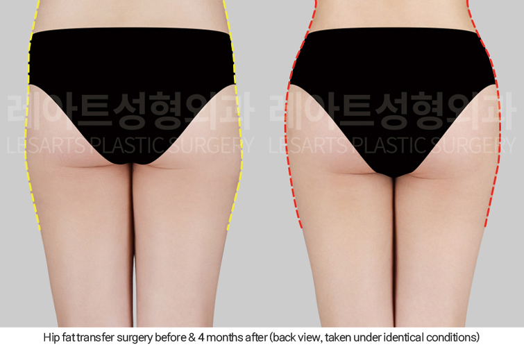 hip_dip_fat_transfer_02_06_250402