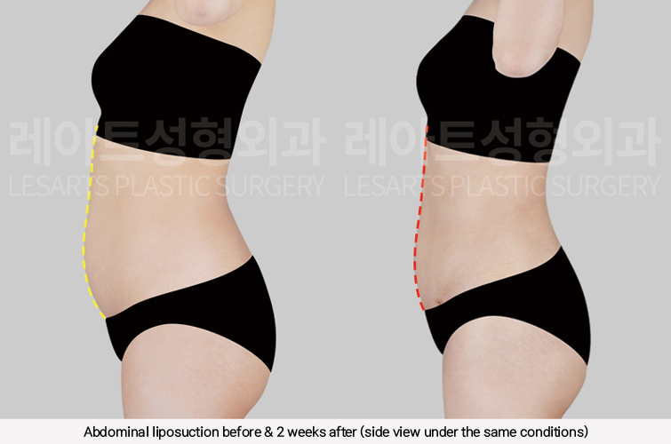 hip_dip_fat_transfer_02_07_250305