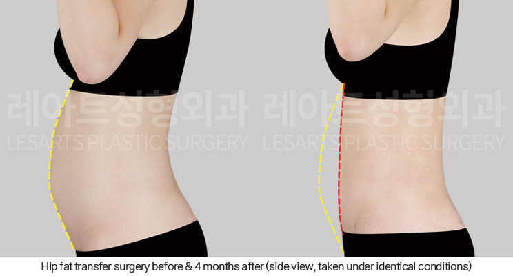 hip_dip_fat_transfer_02_07_250402
