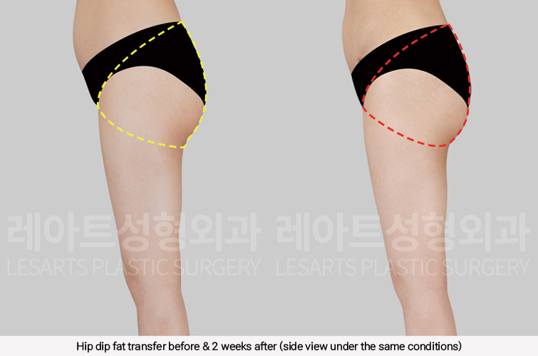 hip_dip_fat_transfer_02_08_250305