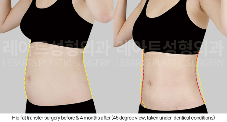hip_dip_fat_transfer_02_08_250402