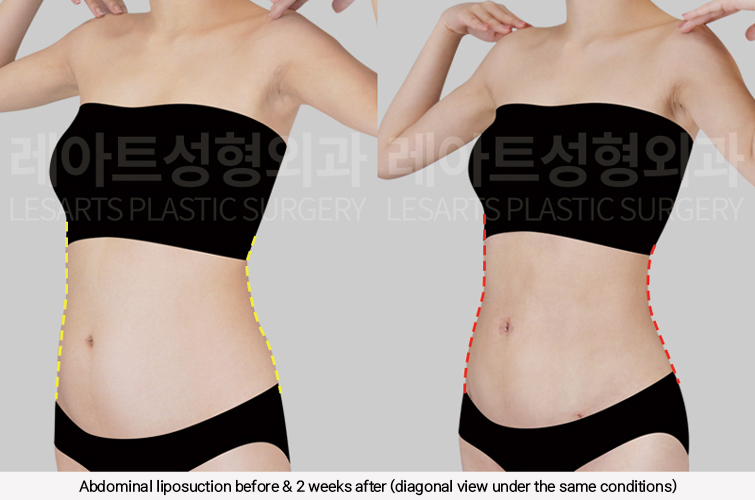 hip_dip_fat_transfer_02_09_250305