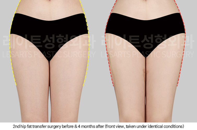 hip_dip_fat_transfer_02_09_250402