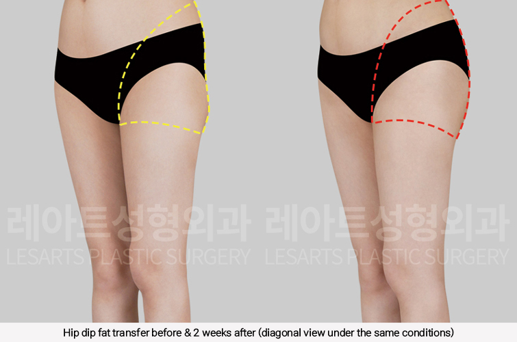 hip_dip_fat_transfer_02_10_250305
