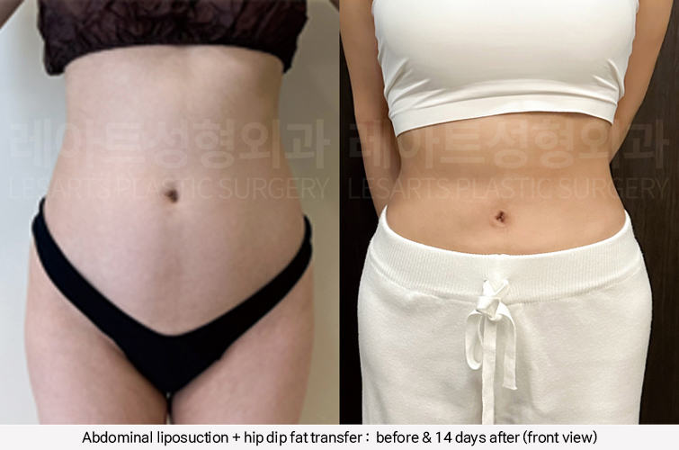 hip_dip_fat_transfer_02_11_250305