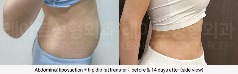 hip_dip_fat_transfer_02_12_250305