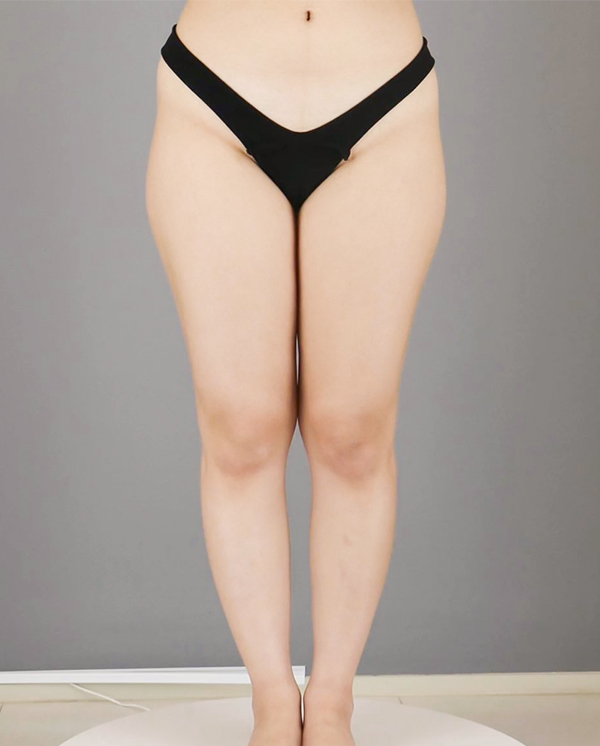 Katachipa's thigh liposuction before photo taken at Lesarts Plastic Surgery in Korea.