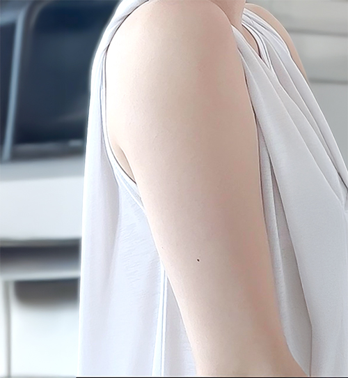 Before photo of kkeoeopdanmariya showing arm and waistline before liposuction at Lesarts Plastic Surgery in Korea.